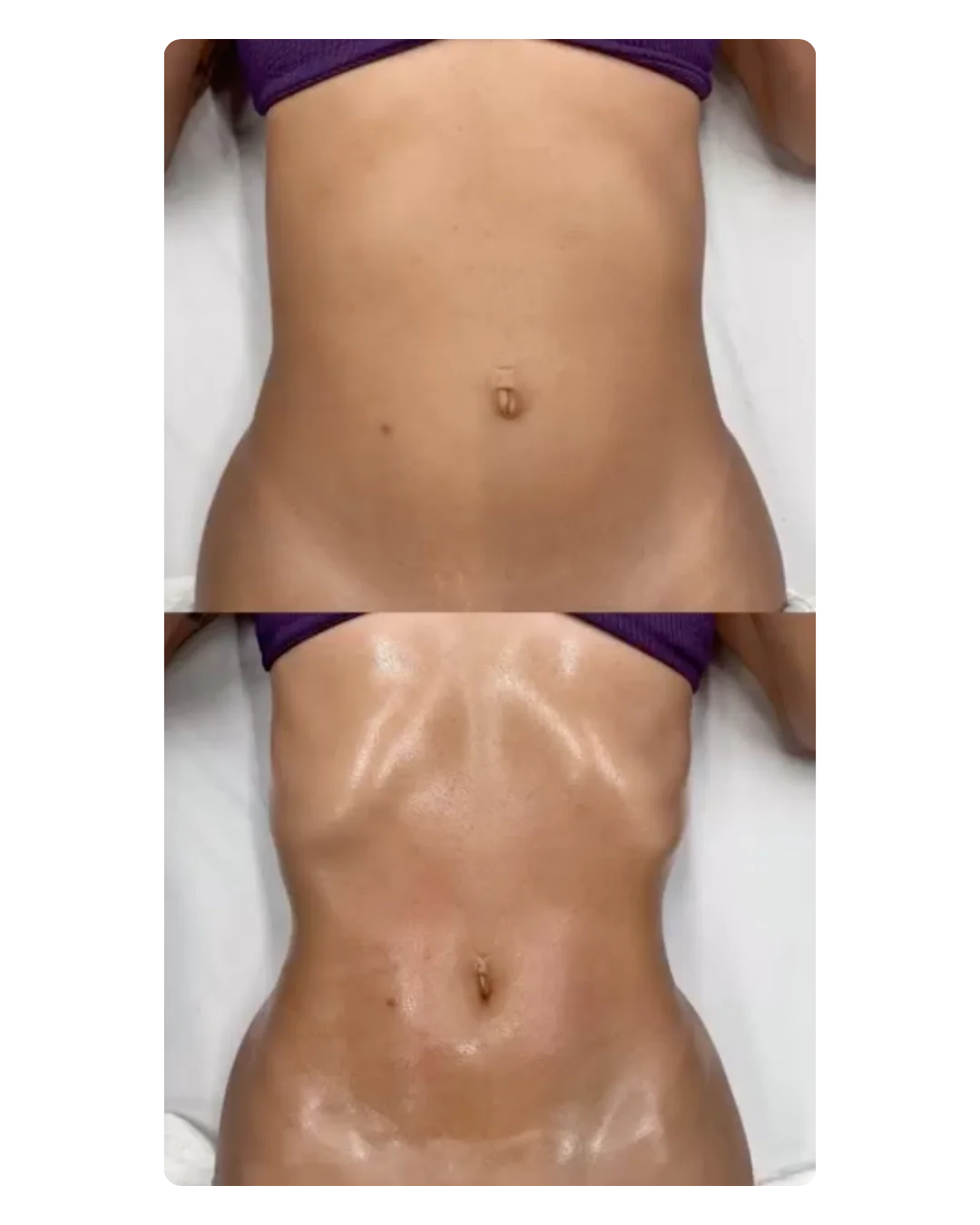 Résultat amincissement abdomen